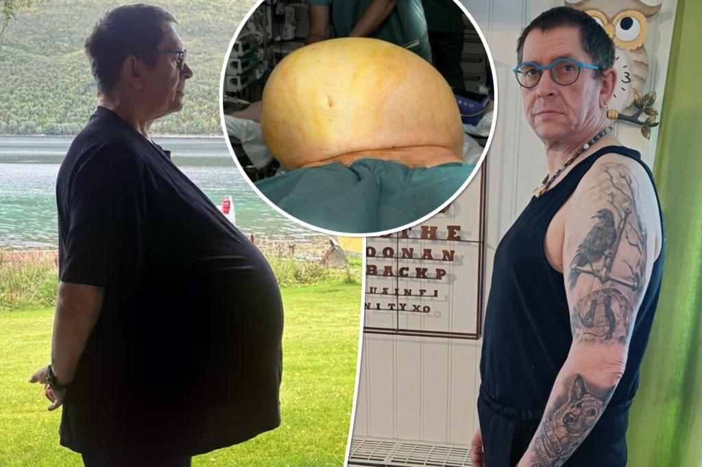 Doctors found a 60-kilogram tumor in the abdomen of a man described as 'healthy'